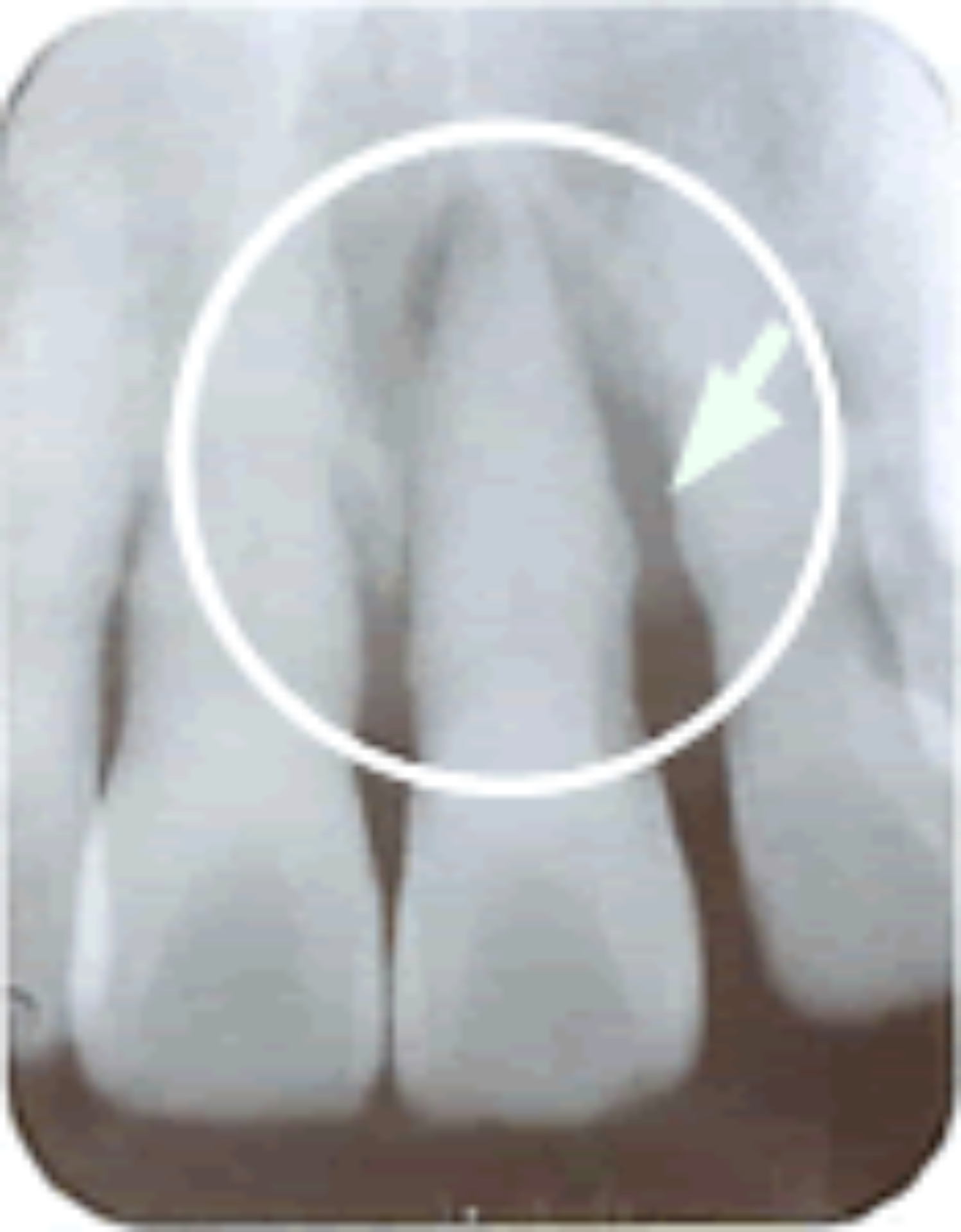 ブラキシズムによって歯周病が悪化している歯のＸ線写真。　