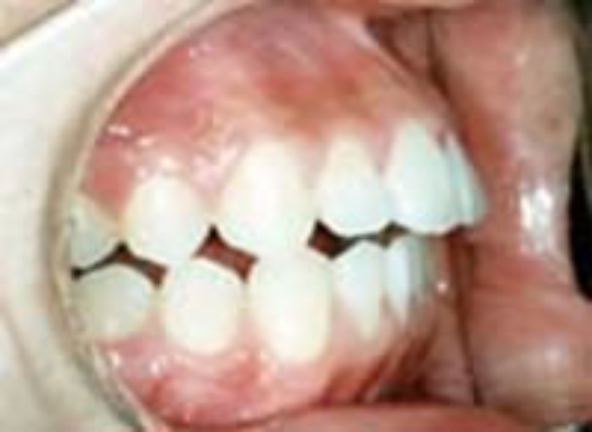 態癖による歯並びへの悪影響