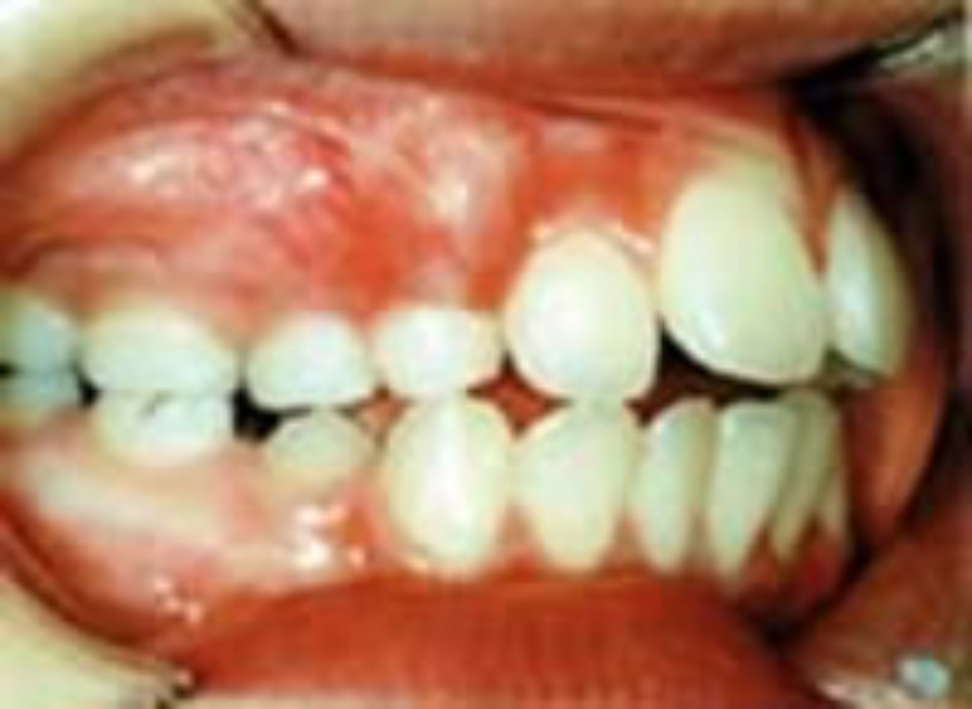 態癖による歯並びへの悪影響