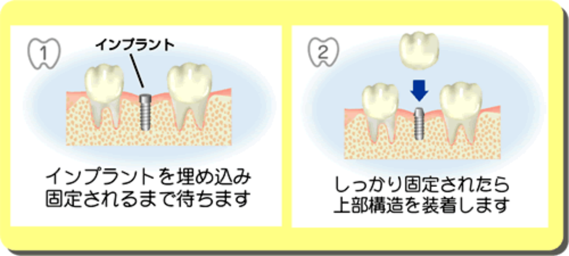 インプラント （入れ歯との比較編）